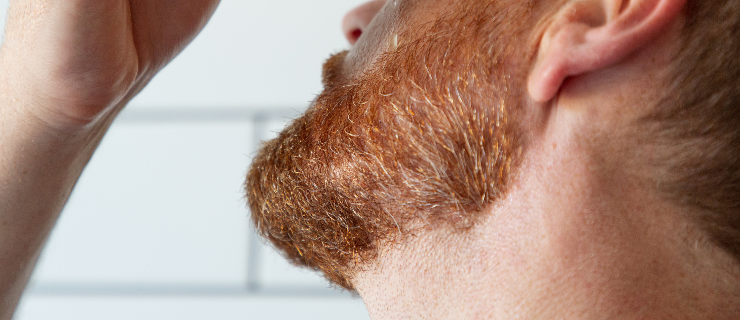 Beard Survival Guide: Ingrown Hairs Edition